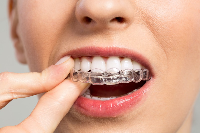 How Long Does Invisalign Take to Work?